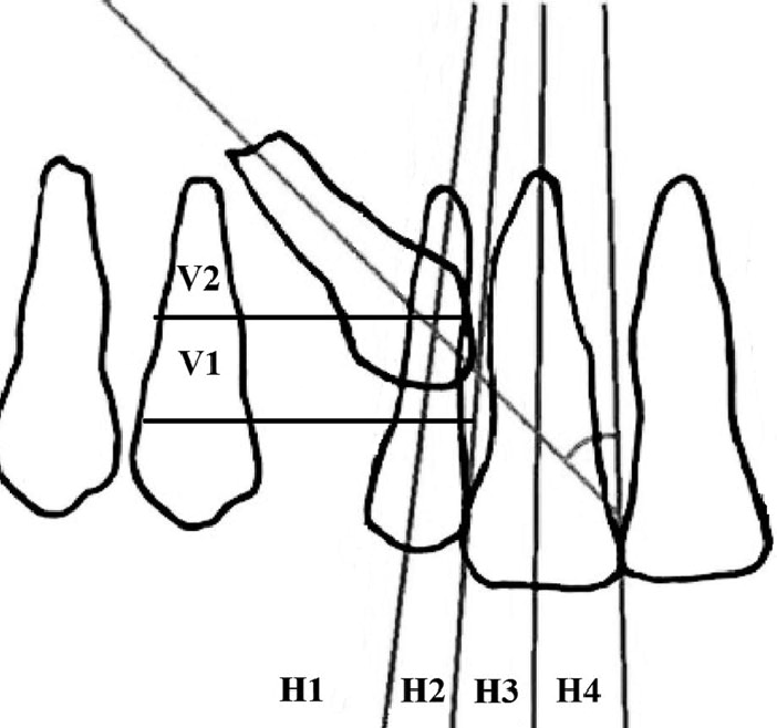 702x658 schematic drawing illustrating the criteria used to define