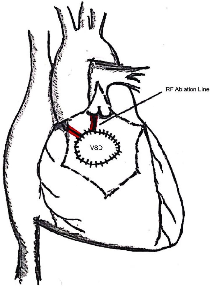 721x986 a drawing depicting the surgical ablation procedure the red lines
