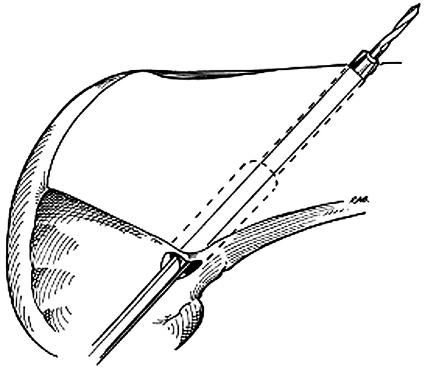 850x744 The Mm Reamer Is Shown Within The Femoral Socket, Extending