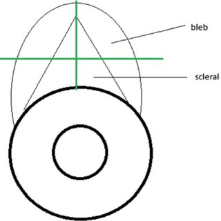 320x320 representative drawing of oct imaging of the filtering bleb
