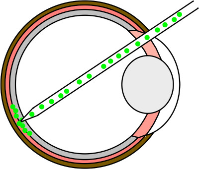 400x341 Subretinal Transplantation Of Macs Purified Photoreceptor