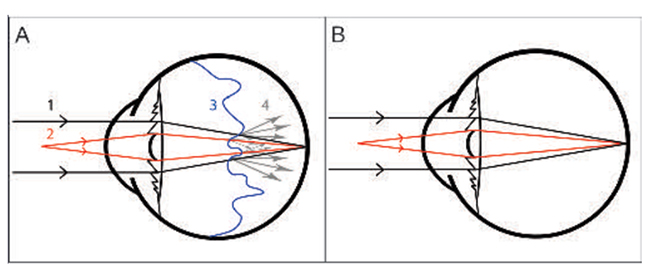 650x268 Tech Trends In Vitreoretinal Surgery