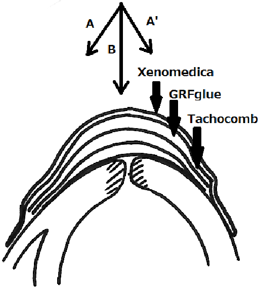 510x569 Schematic Drawing Of The Sutureless Repair Method Using Multiple