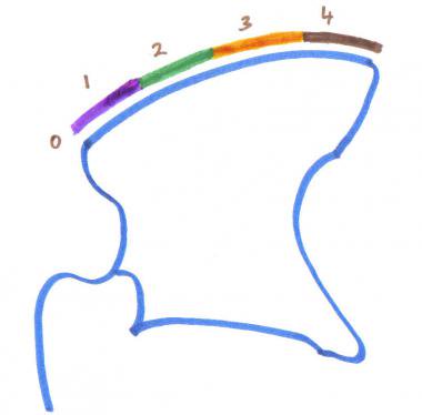 380x374 Idiopathic Scoliosis Imaging Practice Essentials, Radiography