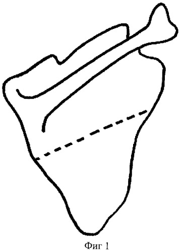 357x499 method of treatment of alar scapula