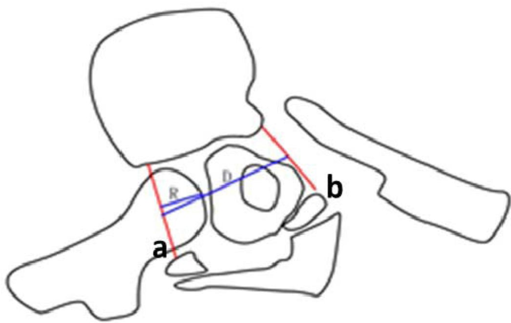 1052x666 posterior correction without rib head resection for patients