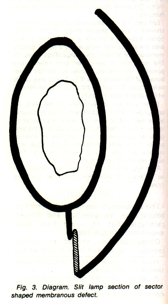 584x1054 Sector Shaped Membranous Cataract