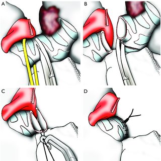 320x320 Drawing Showing The Sequence Of Lower Lobe Sleeve Resection