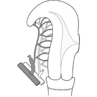 320x320 Schematic Drawing Of Autotransplantation Procedure In The Sheep