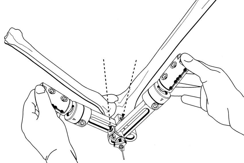850x569 Drawing Showing Application Of The Elbow From The Lateral