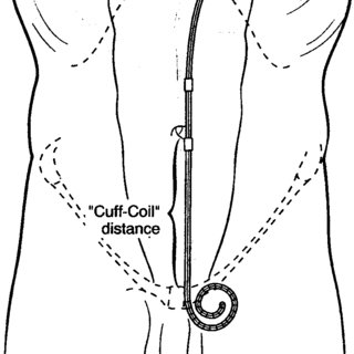 320x320 Schematic Drawing Showing The Manner In Which The Proper Catheter