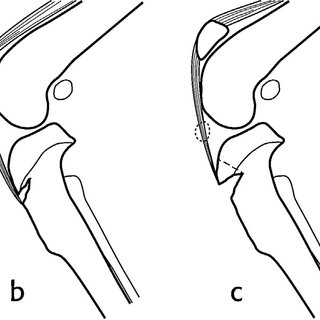 320x320 schematic drawing of the rabbit knee depicting changes seen in osd