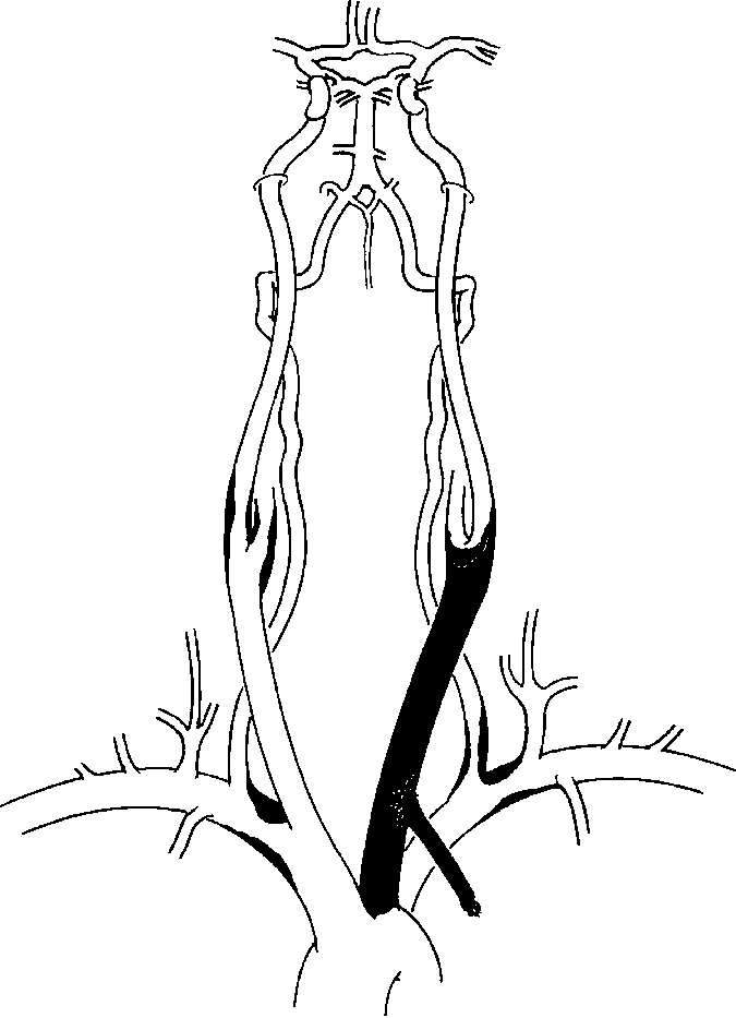 675x933 illustration concerning the first case the supra aortic vascular