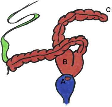 376x357 Diagram Of The Malformation Blue Bladder Red Colon Green