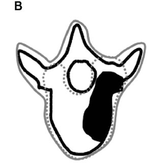 320x320 diagrammatic representation of spinal cord volume definition