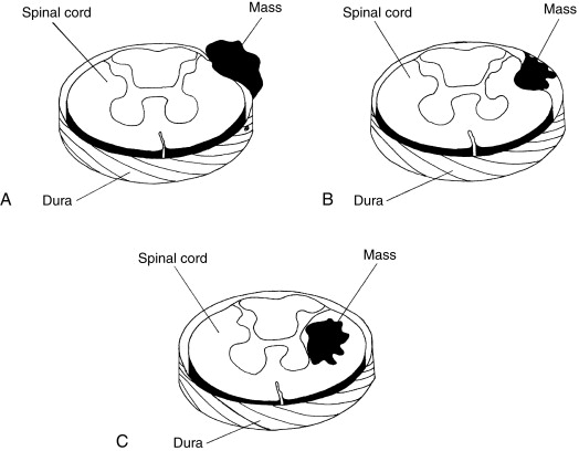524x408 Disorders Of The Spinal Cord And Related Structures