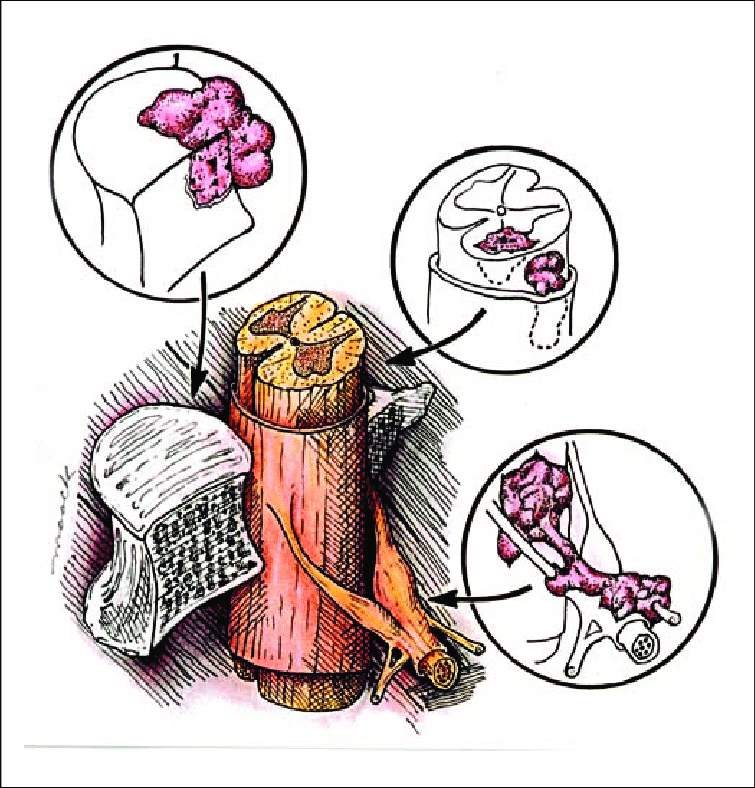 755x788 locations of metastases to the spine most tumor emboli are found