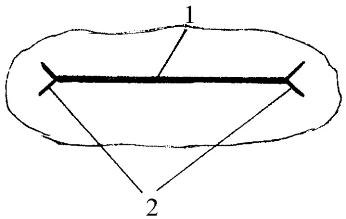 699x443 Method Of Autopsy Of Spinal Cord Pachymeninx Superior