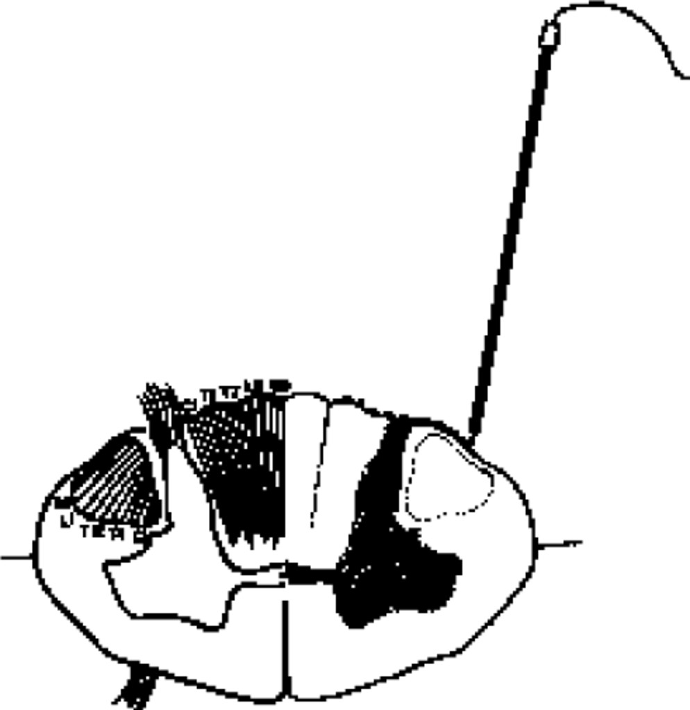 994x1024 Spinal Cord Mapping With Evoked Responses For Accurate