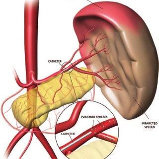320x320 three dimensional drawing of selective partial splenic arterial