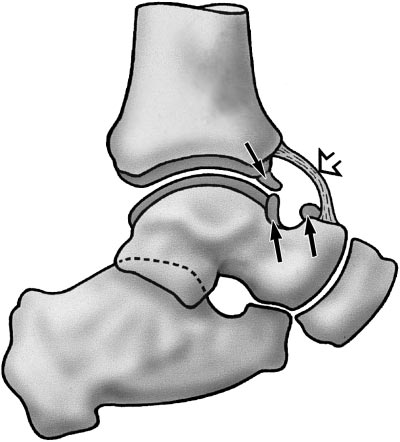 400x442 Drawing Of The Ankle Shows The Most Common Sites For Anterior