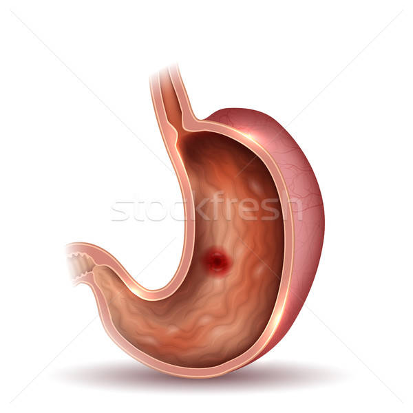 600x600 Stomach Ulcer, Interanl Organs Anatomy Colorful Drawing Vector