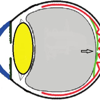 320x320 Schematic Drawing Showing The Severe Vitreous Pressure