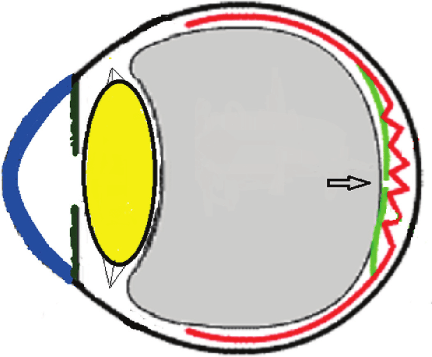 850x704 Schematic Drawing Showing The Severe Vitreous Pressure