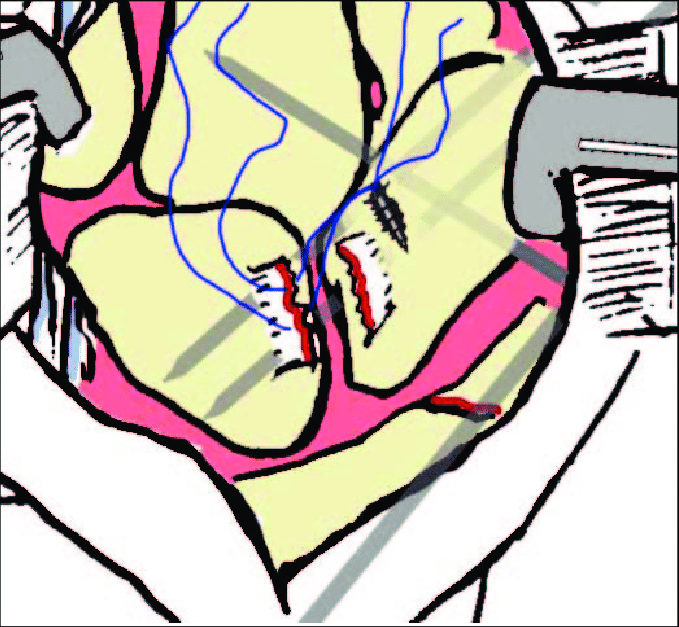 679x627 Scapholunate Ligaments Repair With A Single Dupuy Mitek Titanium