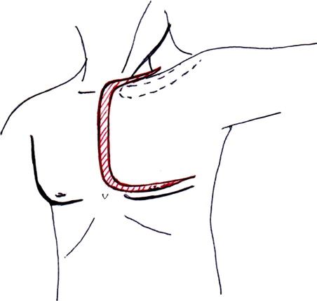 452x430 Trap Door Incision Download Scientific Diagram