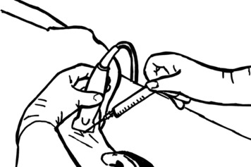 356x237 techniques, advantages, and pitfalls of ultrasound guided internal