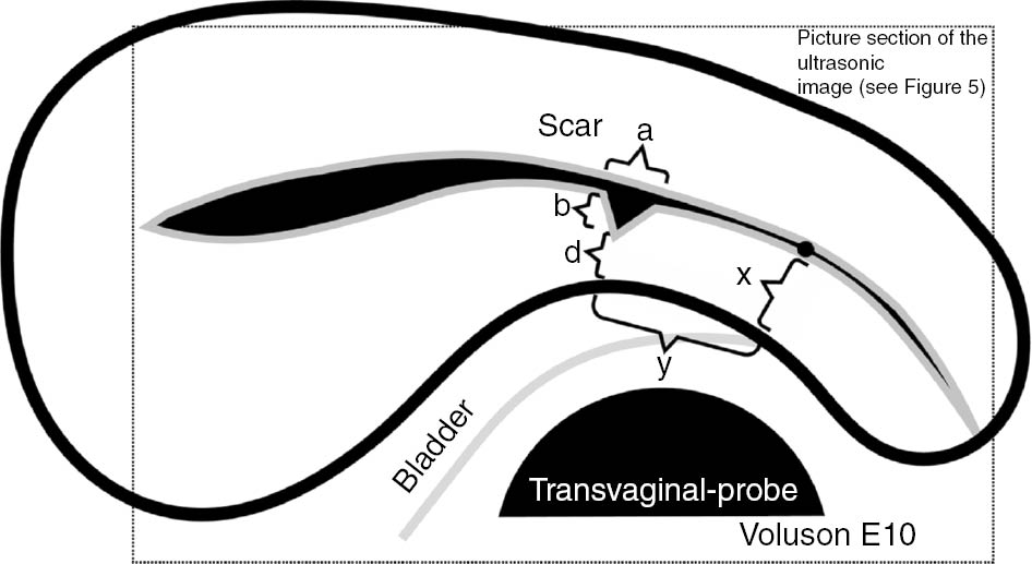 946x517 does ultrasound guided intervention during repeat cesarean
