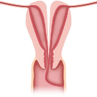320x320 schematic drawing of a uterus didelphys the uterine horns, cervix