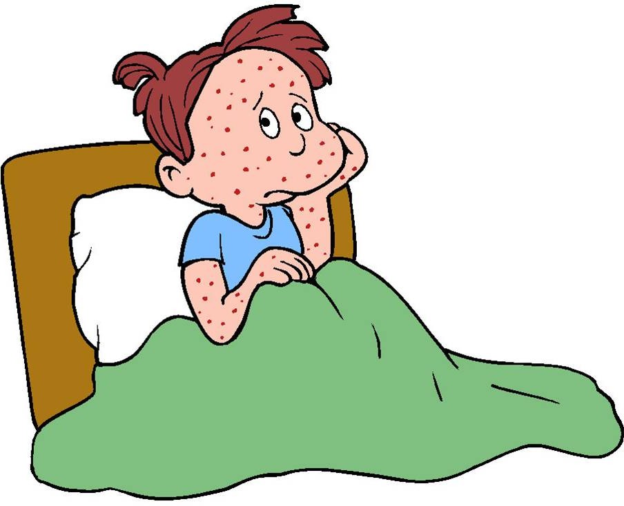 904x734 Chicken Pox Clipart