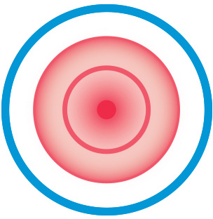 304x312 What Are The Causes Of Diaper Rash