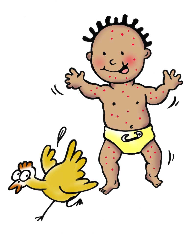 769x980 Chicken Pox Clipart