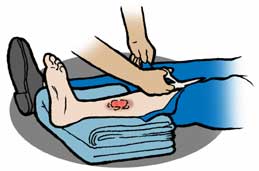 259x171 Burn Clipart Chemical