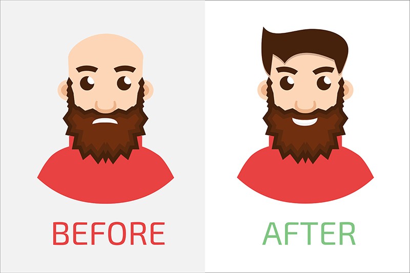 800x533 Hair Transplant Aftercare Essentials Hair Transplant