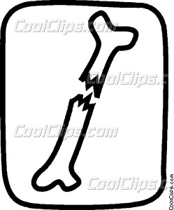 249x300 Broken Bone Vector Clip Art