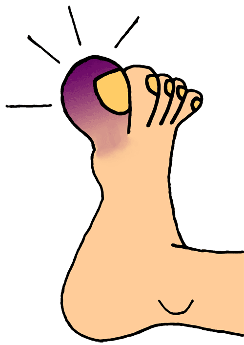 500x706 Swollen Leg Clipart