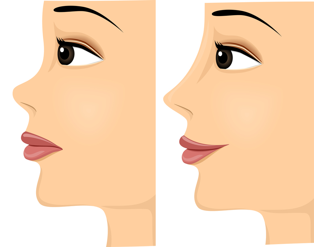 1000x786 Nose.osmanl. Toddler Yellow Duck Costume. Aesthetic Treatment