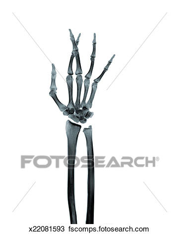 361x470 Drawing Of X Ray Image Of A Hand With Fingers Crossed X22081593