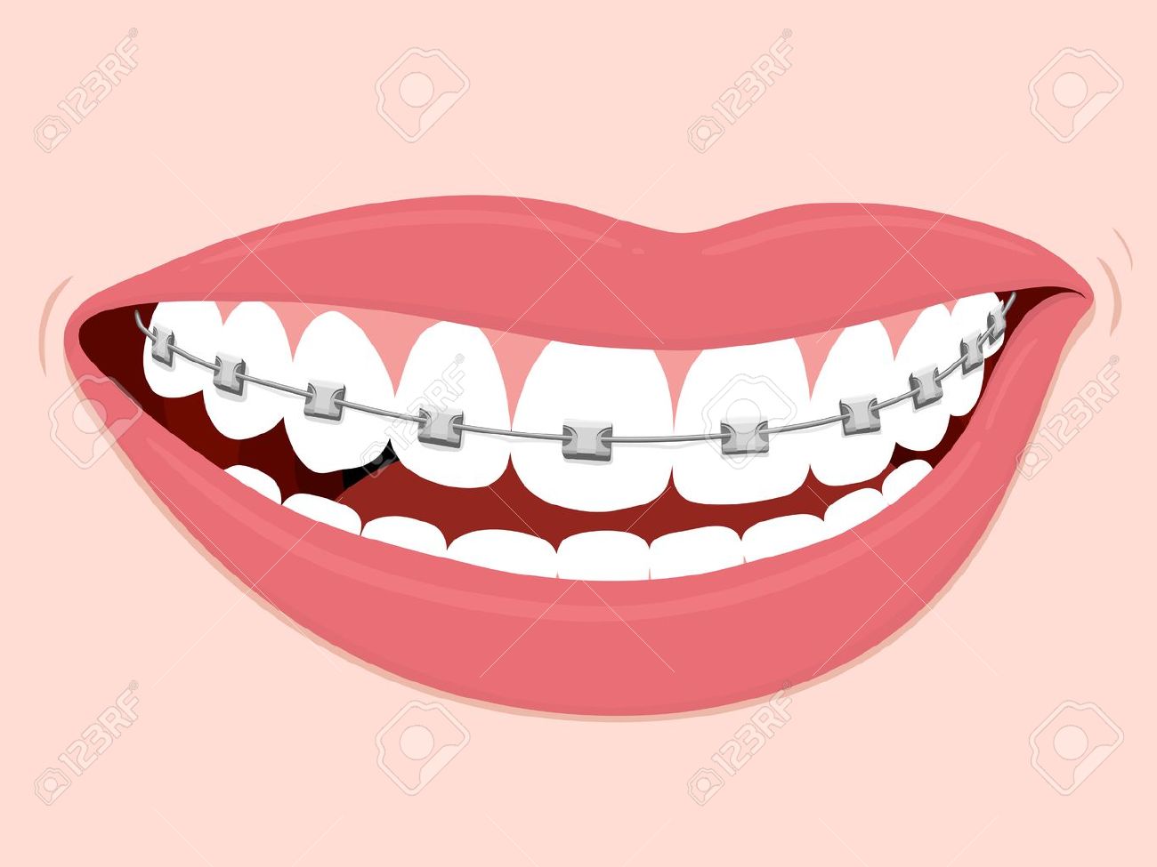 1300x975 Clip Art Teeth With Braces Cliparts