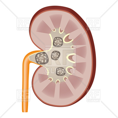 400x400 Detailed Anatomy Of Kidney Cross Section Showing Stones In Kidney