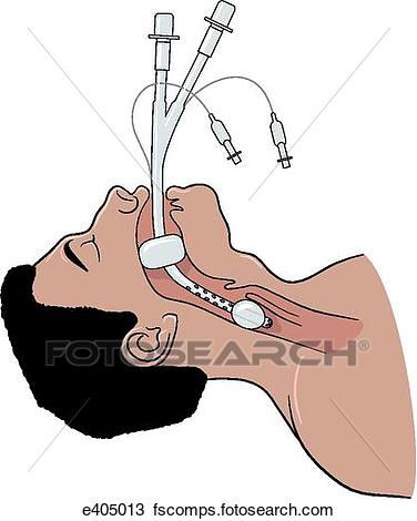 376x470 Drawing Of Combitude Airway In Place E405013