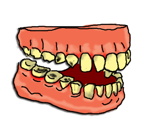 561x507 Teeth Clipart Tooth Decay