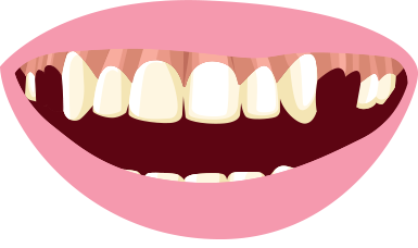 385x228 Clip On Veneers Snap In Smile No Dentist No Drills No Pain