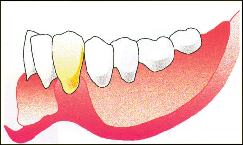 500x300 The Removable Partial Denture Equation British Dental Journal