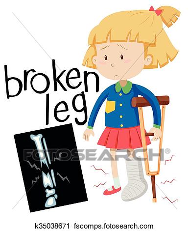 386x470 Clipart Of Girl With Broken Leg And X Ray Film K35038671